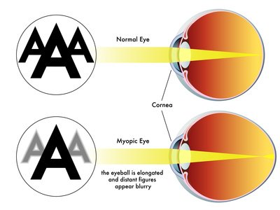 Consejos para mejorar la visión de cerca si eres miope y las gafas no son suficientes